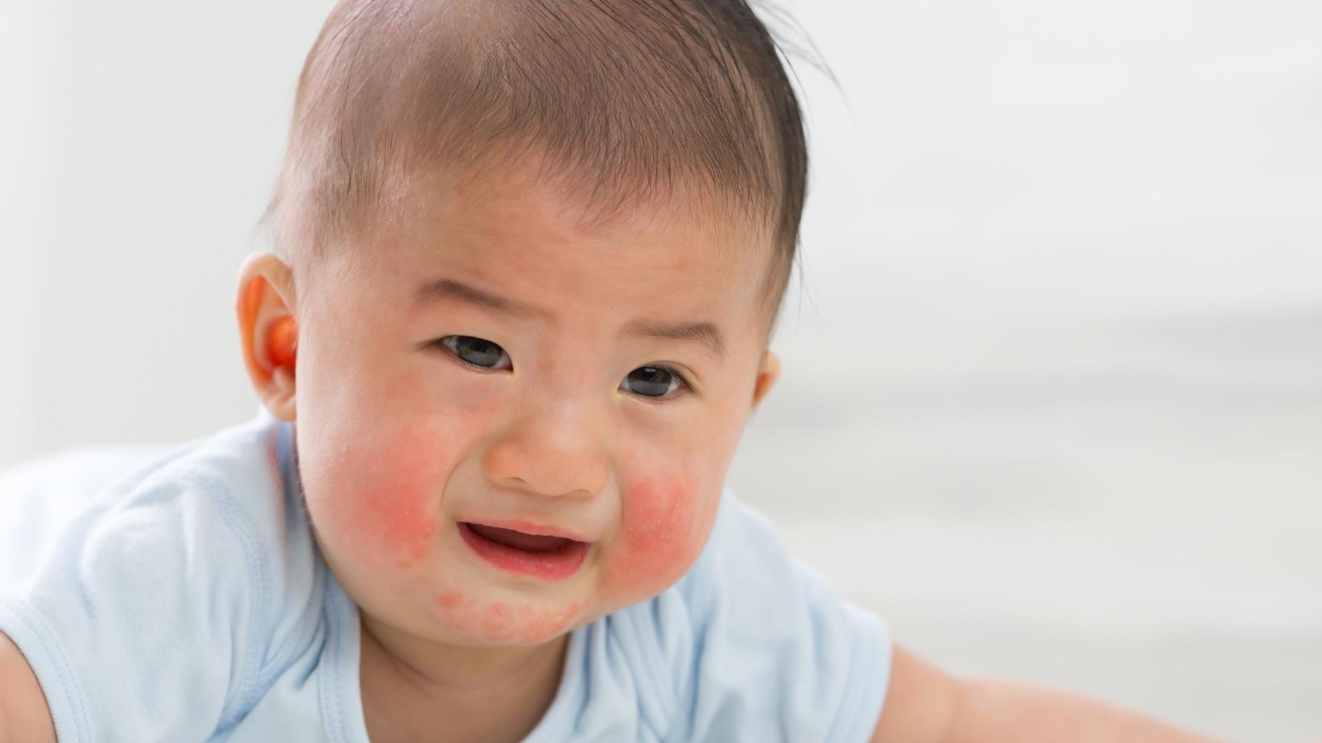 Teething Rash: Causes, Symptoms, Pictures, 7 Top Treatments