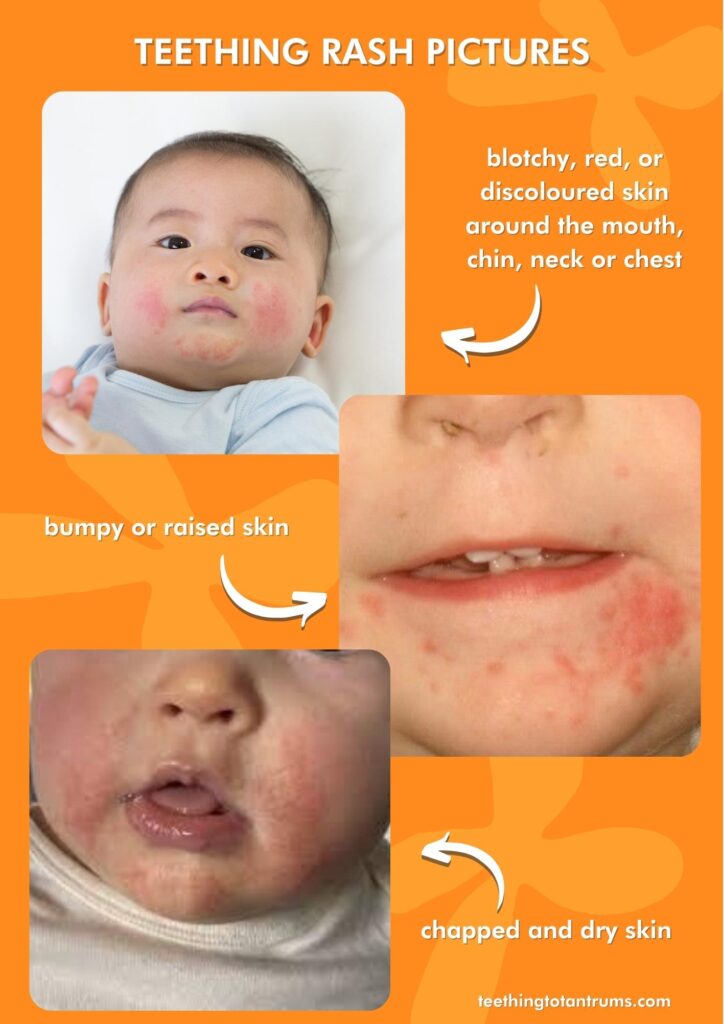 Teething Rash Images